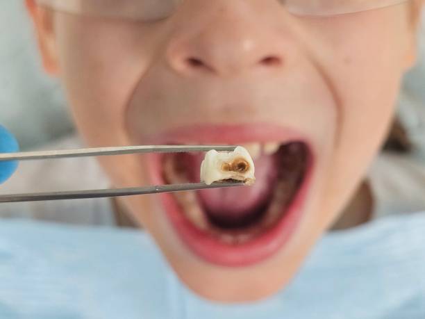 Best Emergency Tooth Extraction in Centerfield, UT